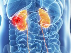 kidney cancer