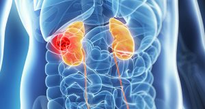 kidney cancer