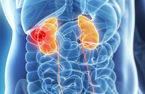 kidney cancer