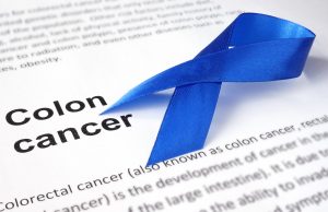 Colon Cancer Prevention