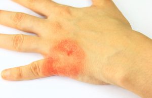 psoriasis