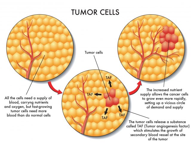 Cancer