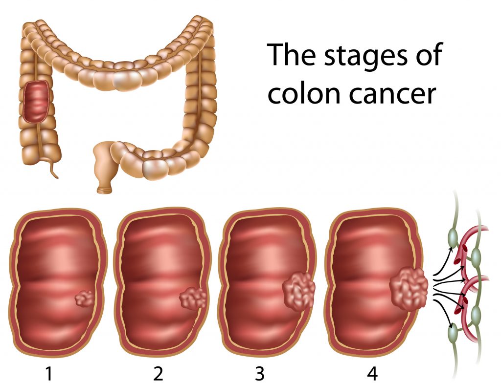 colorectal cancer