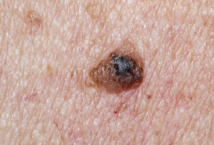 melanoma