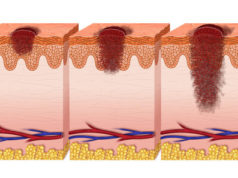 melanoma