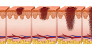 melanoma