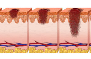 melanoma