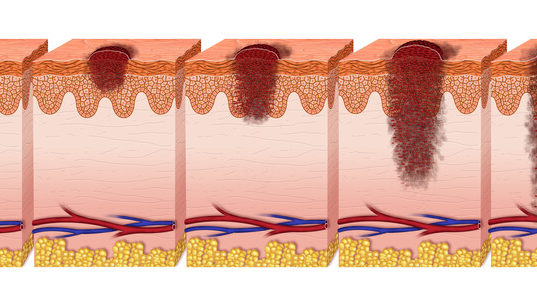 melanoma